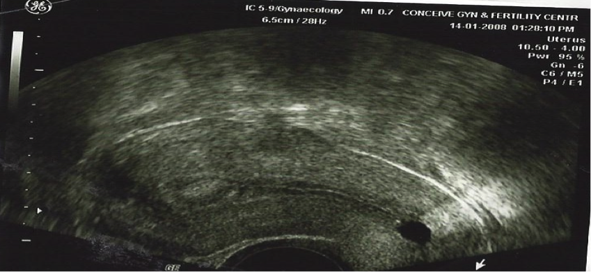 Endometrial Polyp Seen By A Vaginal Ultrasound Scan Conceive Ivf Hospital 